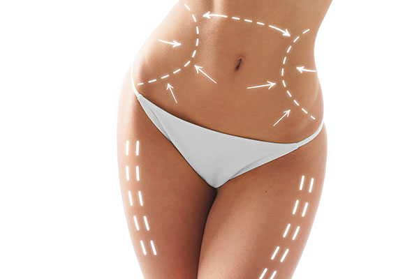 Fettpolster im Bereich der Arme, der Innenseiten der Oberschenkel und Knie, sowie den Unterschenkeln, Waden und Fesseln sehr gleichmäßig absaugen und modellieren. 